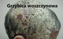 Grzybica woszczynowa