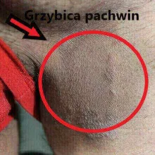 Grzybica pachwin 