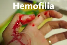 Hemofilia