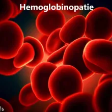 Hemoglobinopatia