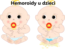 Hemoroidy u dzieci, hemoroidy u dziecka