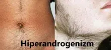 Hiperandrogenizm