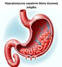 Hiperplastyczne zapalenie błony śluzowej żołądka, polipy hiperplastyczne, rozrostowe zapalenie żołądka