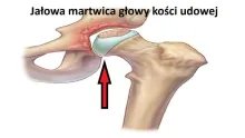 Jałowa martwica głowy kości udowej 