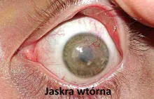 Jaskra wtórna 
