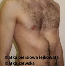 Klatka piersiowa lejkowata, klatka szewska 