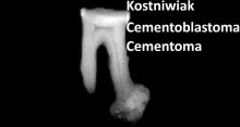 Kostniwiak, cementoblastoma, cementoma