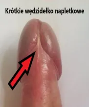 Krótkie wędzidełko napletkowe