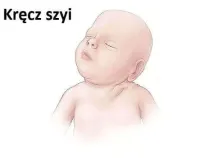 Kręcz szyi