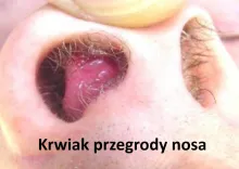 Krwiak przegrody nosowej, Krwiak przegrody nosa