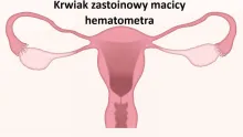 Krwiak zastoinowy macicy, hematometra
