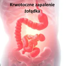 Krwotoczne zapalenie żołądka, ostra gastropatia krwotoczna nadżerkowa