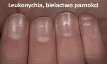 Leukonychia, bielactwo paznokci, białe pazonkice
