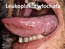 Leukoplakia włochata, hairy leukoplakia 