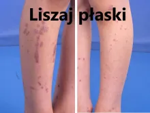 liszaj płaski 