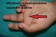 Młodzieńcze reumatoidalne zapalenie stawów 