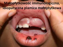 Małopłytkowość immunologiczna, idiopatyczna plamica małopłytkowa