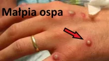 Małpia ospa 