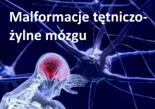 Malformacje tętniczo-żylne mózgu 