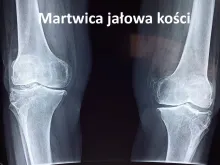 Martwica jałowa kości 