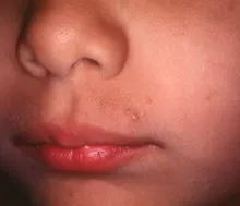 Mięczak zakaźny u dzieci 