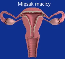 Mięsak macicy 