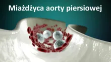 Miażdżyca aorty piersiowej 