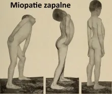  Miopatie zapalne 