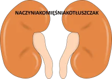 NACZYNIAKOMIĘŚNIAKOTŁUSZCZAK 