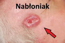 Nabłoniak 