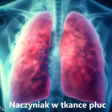 Naczyniaki w tkance płuc, naczyniaki w płucach