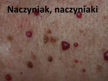 naczyniak, Naczyniaki 