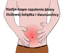 Nadżerkowe zapalenie błony śluzowej żołądka i dwunastnicy 