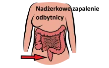 Nadżerkowe zapalenie odbytnicy, nadżerki błony śluzowej odbytnicy
