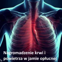 Nagromadzenie krwi i powietrza w jamie opłucnej, hemopneumothorax, haemopneumothorax
