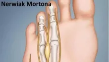 Nerwiak Mortona, choroba Mortona, metatarsalgia Mortona, neuralgia Mortona, nerwiak międzyśródstopny