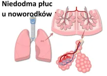 Niedodma płuc u noworodków 