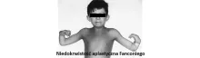 Niedokrwistość aplastyczna Fanconiego 