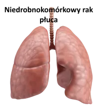 Niedrobnokomórkowy rak płuca 