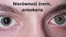 Nierówność źrenic, anizokoria