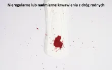 Nieregularne lub nadmierne krwawienia z dróg rodnych 