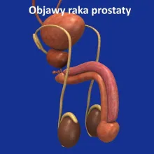 Objawy raka prostaty 