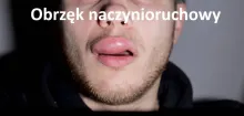 Obrzęk naczynioruchowy 