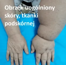 Obrzęk uogólniony skóry, tkanki podskórnej 