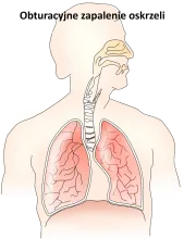 Obturacyjne zapalenie oskrzeli