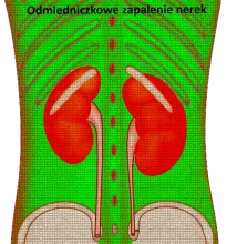 Odmiedniczkowe zapalenie nerek 
