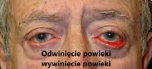 Odwinięcie powieki, wywinięcie powieki, ektropion