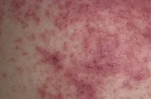 Opryszczkowate zapalenie skóry choroba Duhringa