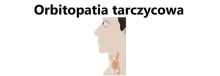 Orbitopatia tarczycowa 