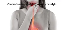 Owrzodzenie przełyku, wrzody przełyku 